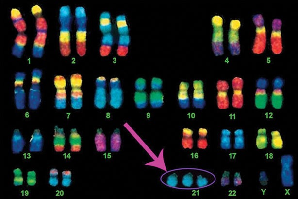 Chromosomes showing Trisomy21